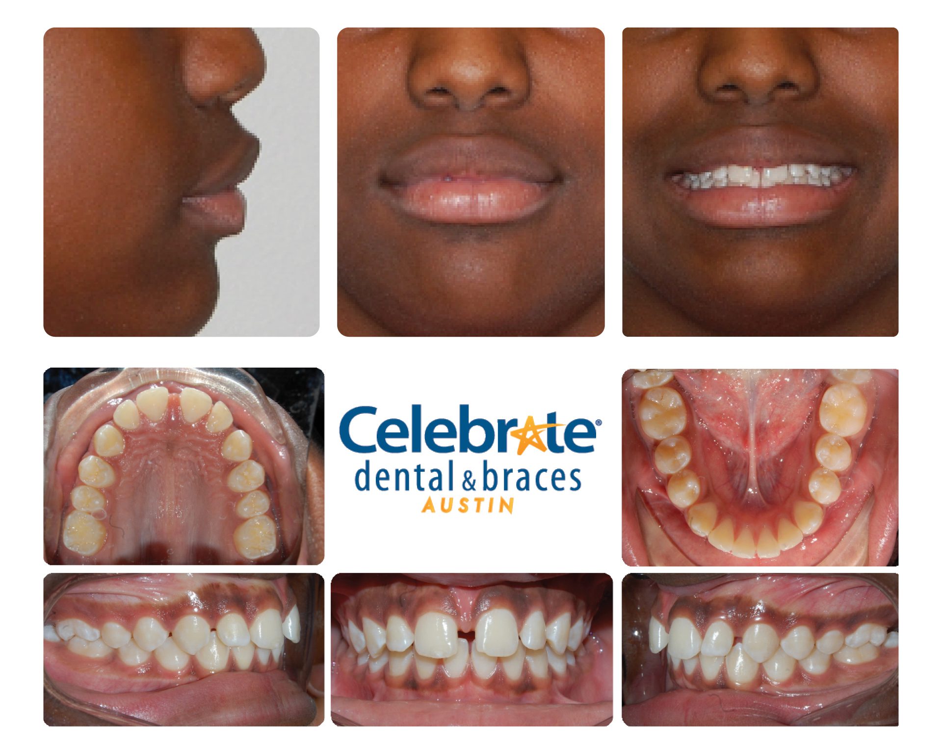 teeth before and after braces