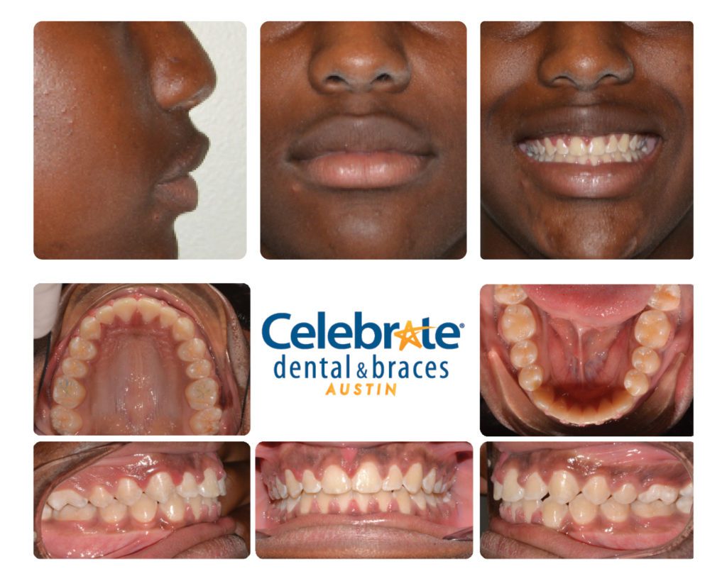 teeth before and after braces