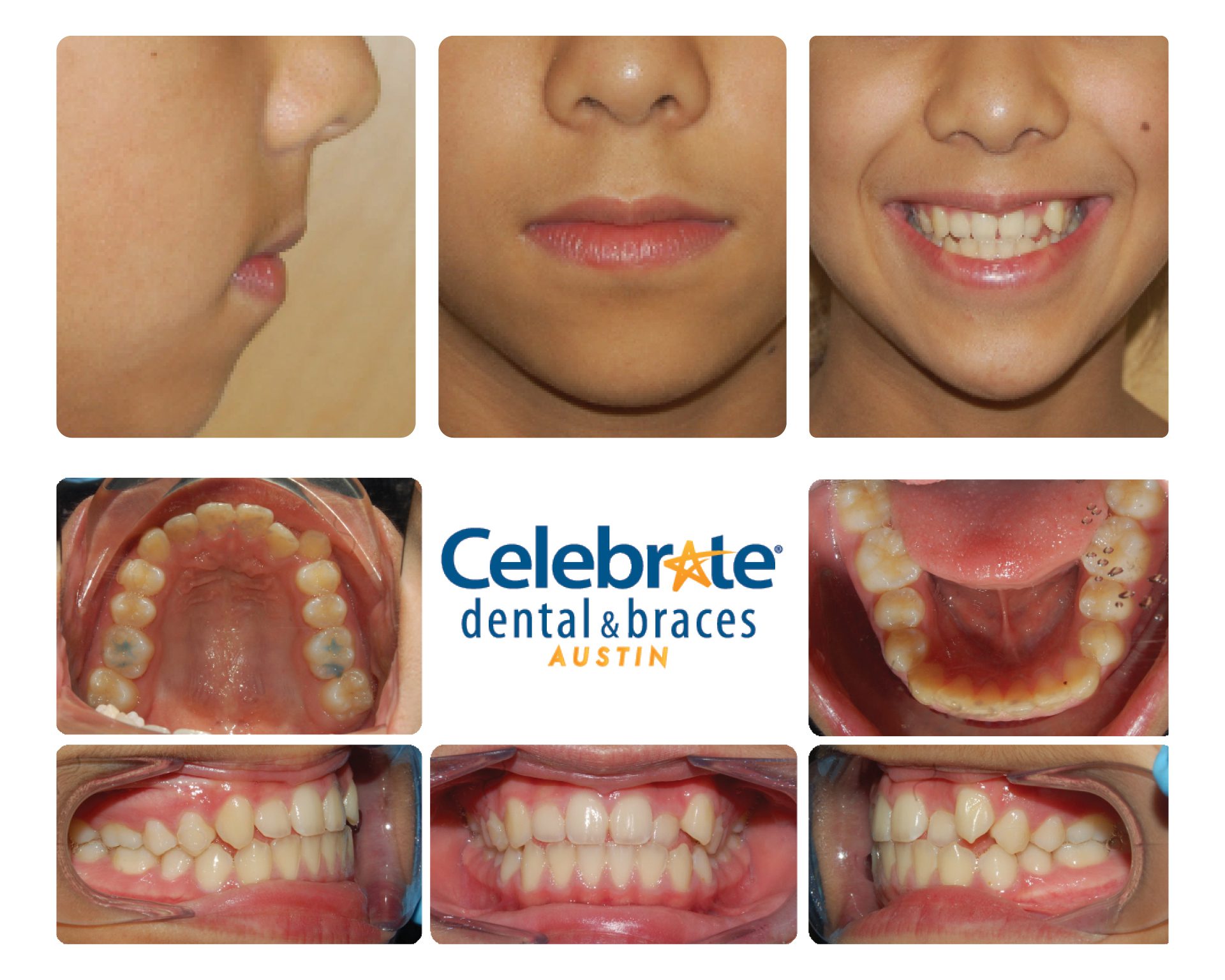 teeth before and after braces