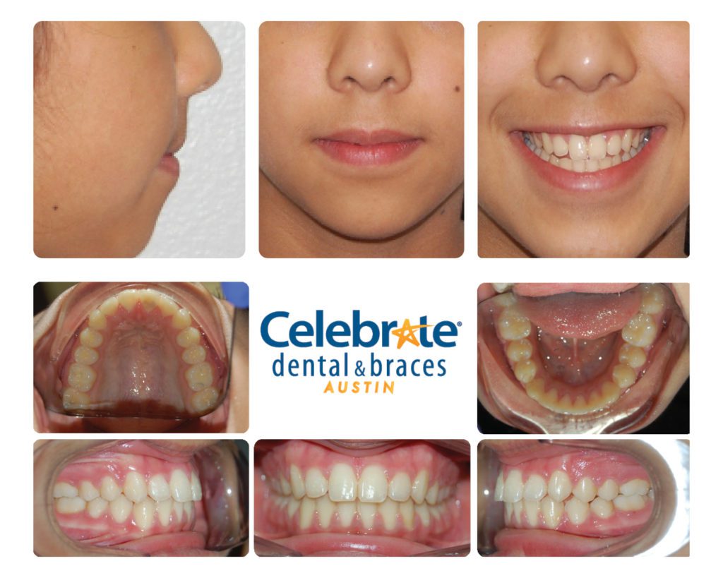 teeth before and after braces