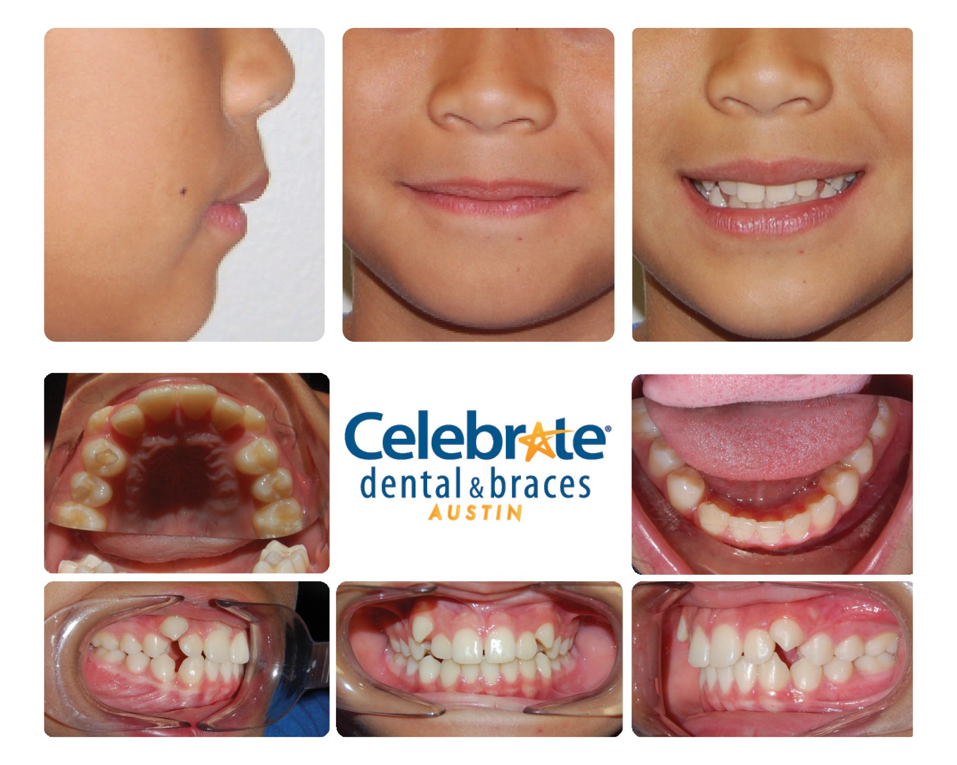 teeth before and after braces