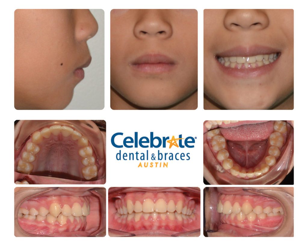 teeth before and after braces