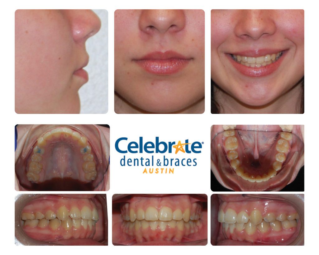 teeth before and after braces