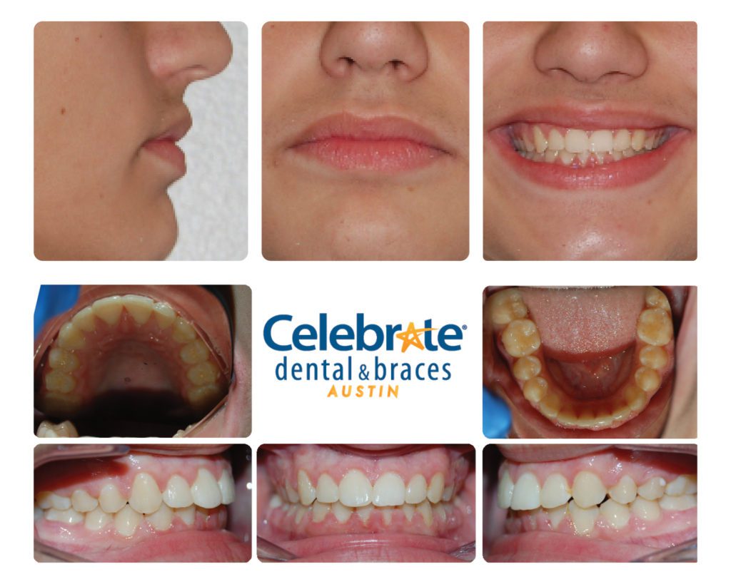 teeth before and after braces