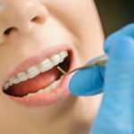 Woman with ceramic braces on teeth at the dental office