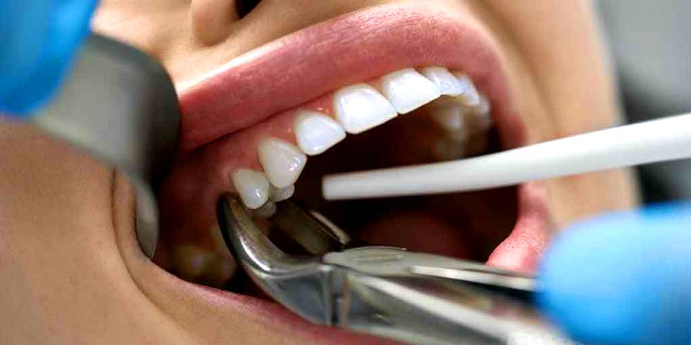 tooth extraction in austin