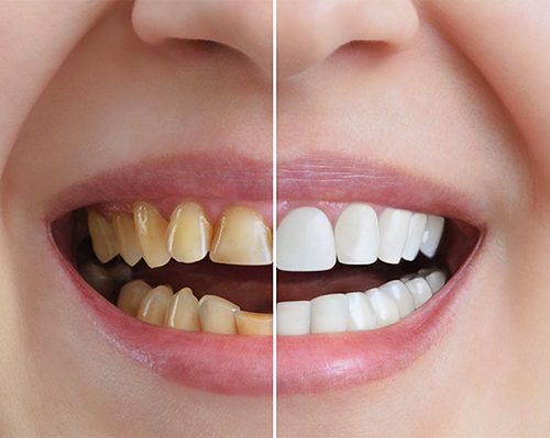 teeth whitening cost