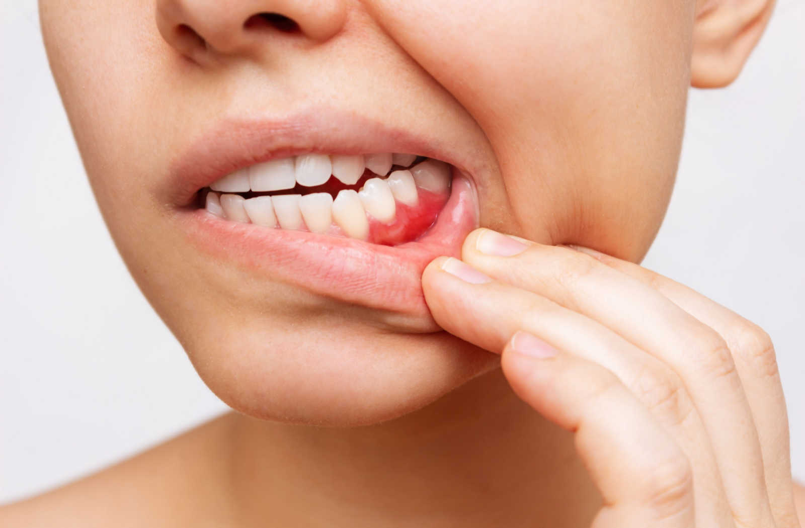 Why Do Gums Bleed