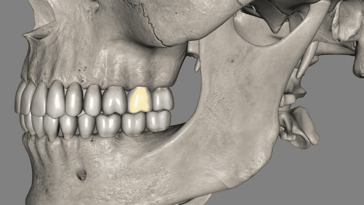 dental implant fell out