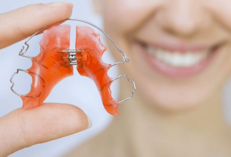 orthodontic palatal expander