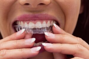 Who is Eligible for Invisalign in Austin