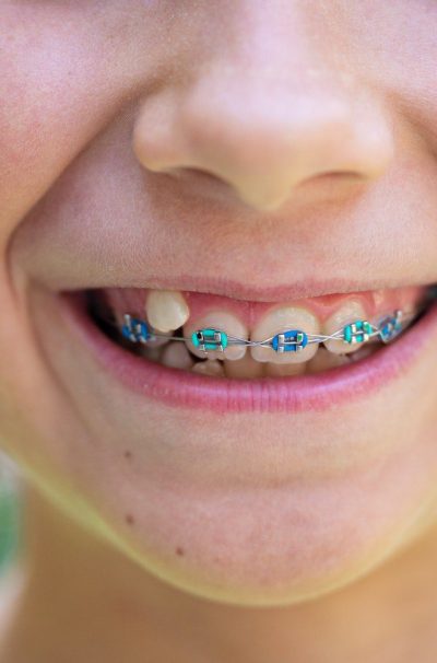 Child with dental braces