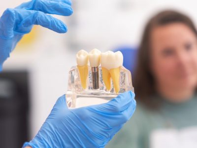 Close-up of dental model with implant. patient of dental clinic on blurred background. dentistry concepts