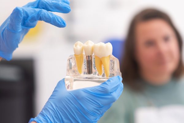 Close-up of dental model with implant. patient of dental clinic on blurred background. dentistry concepts